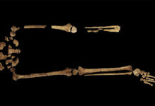 Die älteste bekannte chirurgische Amputation erfolgte vor 31.000 Jahren