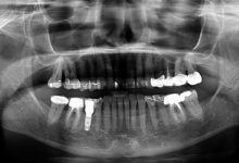 Falsche Zähne könnten als Hörgeräte dienen